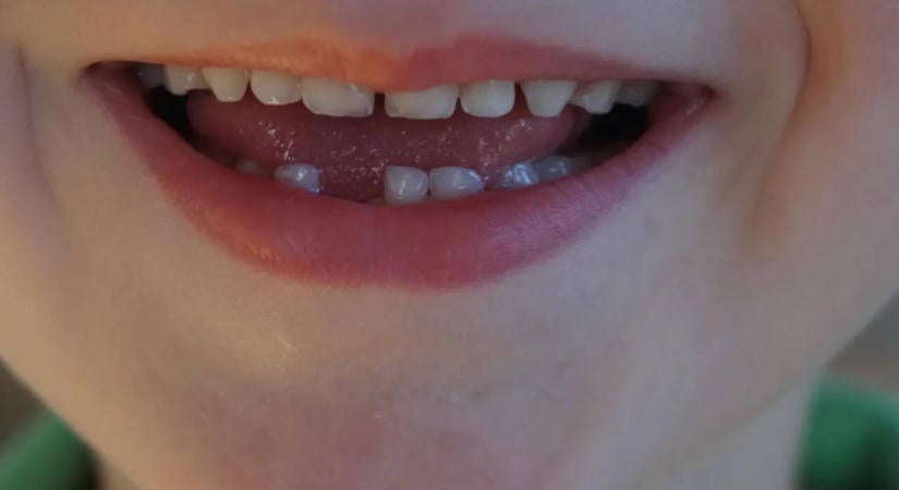 Autizmus és vegyi anyagok: meglepő különbségeket mutatott ki a tejfogak vizsgálata