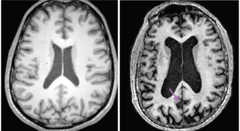 Szegedi kutatók megcsinálták: jöhet az Alzheimer-vérteszt