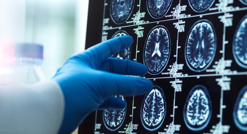 Áttörés jöhet az Alzheimer-kór kezelésében: megfejtették a demencia egyik titkát