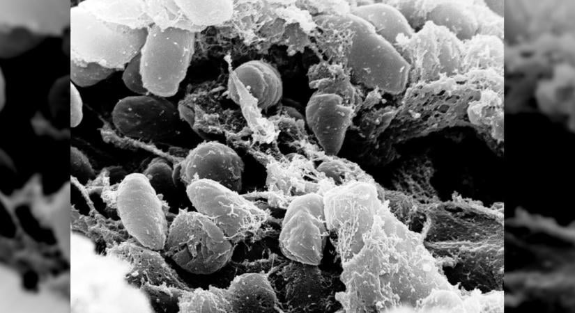 Pestisgyanús eset Oroszországban: miért veszélyes a tüdőpestis?