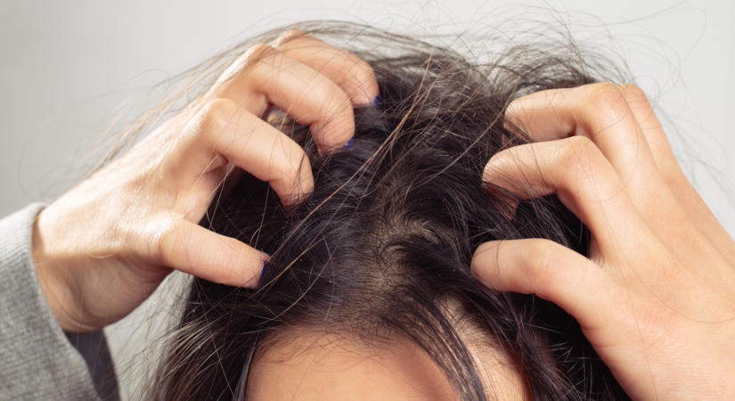 Állandóan vakarnod kell a fejed? A korpánál komolyabb oka is lehet