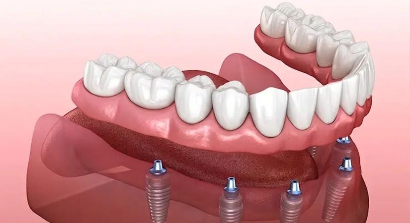 Implantológiai kezelések a győri Smile Zentrum Fogászati Klinikán