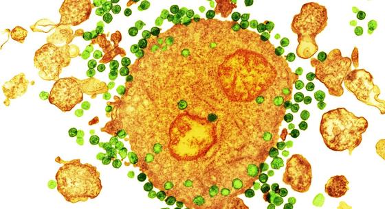 Egy mRNS-módszer csalogathatja elő a szervezetben rejtőző HIV-vírust, hogy aztán végleg elpusztítható legyen