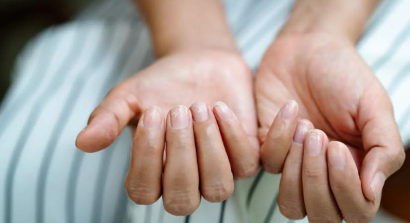 A körmöd is jelezheti a pajzsmirigy zavarát: öt elváltozás, amit érdemes kivizsgáltatni