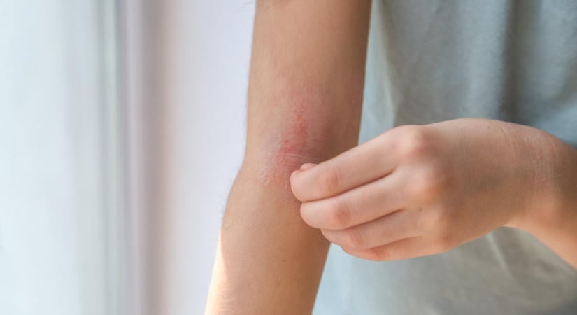 Mit mond el a benned lévő feszültségről az ekcéma és a kiütés?