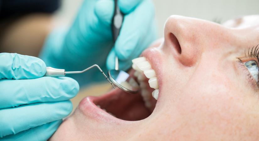 Súlyos betegséget szúrhat ki a fogorvos – Megdöbbentő, miről árulkodik a fogkő