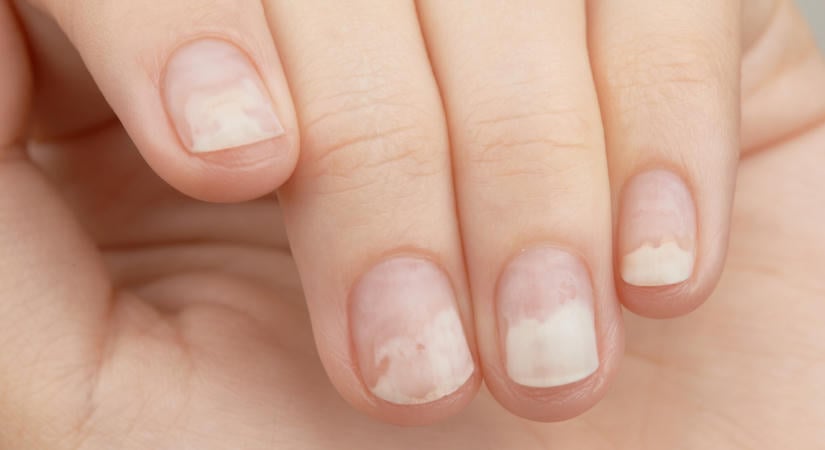 Biztos jelek, hogy a köröm elvált a körömágytól – Mutatjuk, hogy kezelhető a probléma