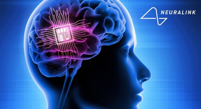 Gondolatokat alakít beszéddé a Neuralink agyimplantátuma