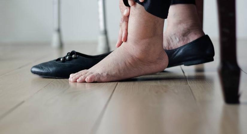 A kevés folyadékfogyasztás is lábdagadást okozhat: ez a 4 rendellenesség állhat a hátterében