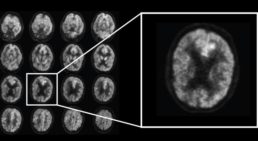 Lehet, hogy eddig rosszul tudták: nem biztos, hogy az agyban kell keresni az Alzheimer-kór okát