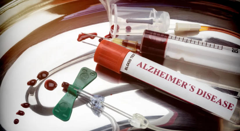 Vérátömlesztéssel is terjedhet az Alzheimer-kór?