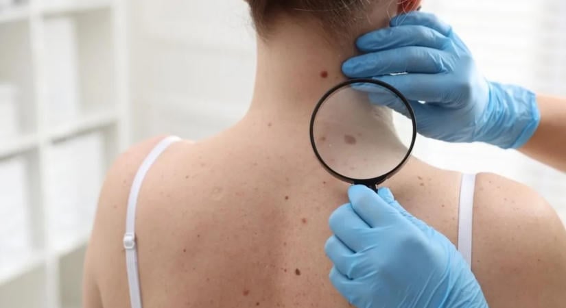 Megváltoznak az anyajegyeid a napfénytől? Mutatjuk, miért veszélyes