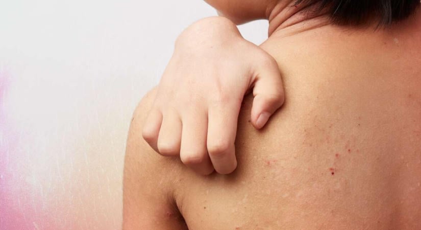 „Három hónap alatt visszakaptuk a gyerekünket” – Amikor az atópiás dermatitisz az egész család életét átírja