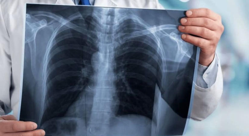 Hétfőn indul a jelentkezés: ingyenes tüdőszűrésre várják a mezőtúriakat