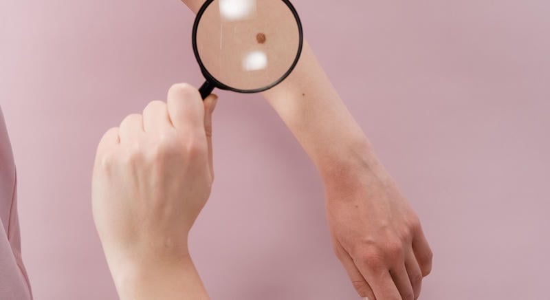 Nézz rá a bőrödre! – Életmentő lehet a szűrés és a fényvédelem