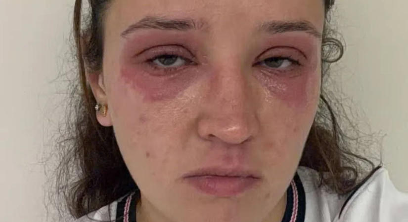 Élete legszebb napja rémálommá vált: súlyos allergiás reakció torzította el a menyasszony arcát