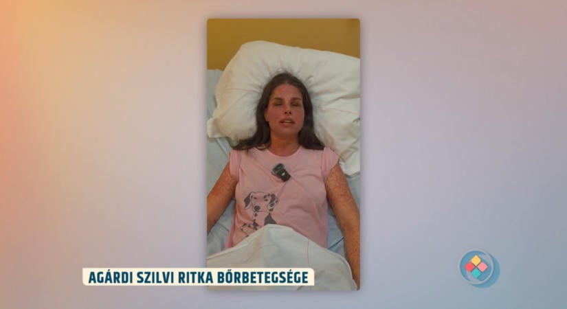 Nem lesz könnyű megnézni a videót: ritka, súlyos bőrbetegséggel küzd Agárdi Szilvi