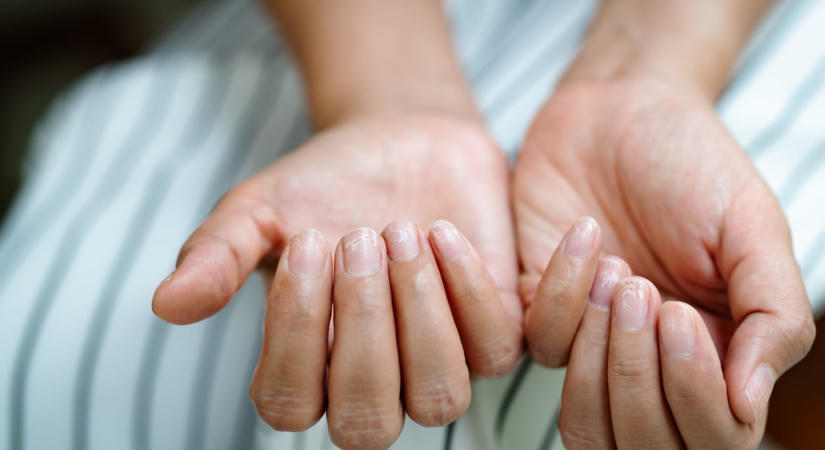 5 jel a körmödön, ami nem vitaminhiányra, hanem komoly pajzsmirigy-problémára figyelmeztet