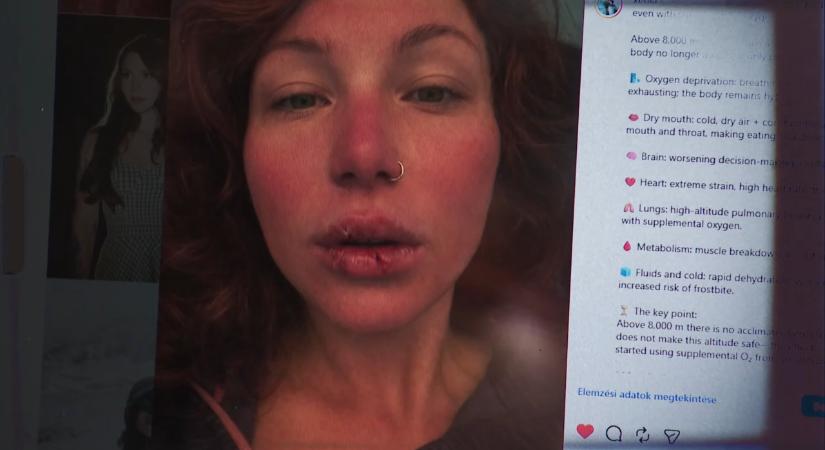 Fagyási sérülésekkel és agyi ödémával került kórházba a Manaszlu megmászása után Sántha Xénia