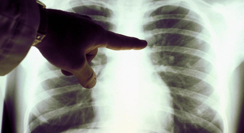 Októbertől új immunterápiás lehetőség nyílik a tüdőrákos betegek előtt