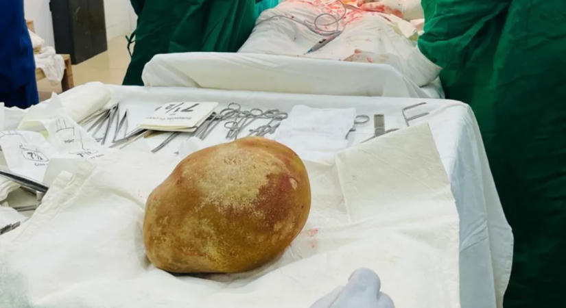 3,5 kilós követ szedtek ki egy férfi hólyagjából, aki nem vette észre, hogy kifejlett csecsemő súlyú, strucctojásnyi szikla akadályozza a vizelésben egy évtizede