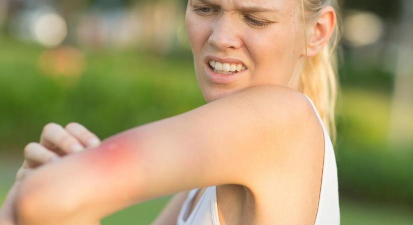 Ezek a darázscsípés allergia tünetei – ilyenkor azonnal orvosra van szükség