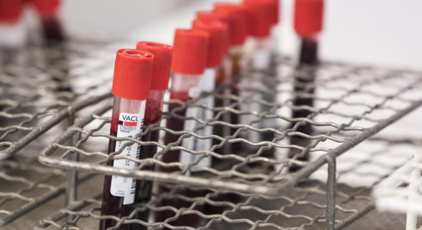 Alzheimer-vértesztet fejlesztenek szegedi kutatók