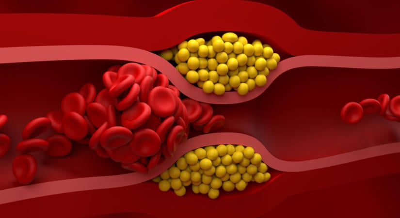 Újfajta stroke-kezelés, elsőként Kecskeméten alkalmazták