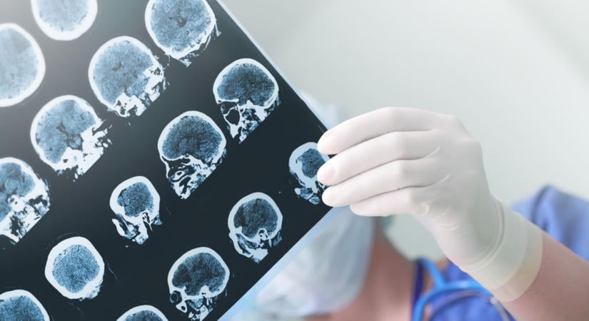 Stroke: egyre több a fiatal beteg – Háromféle ok állhat az agyvérzés hátterében