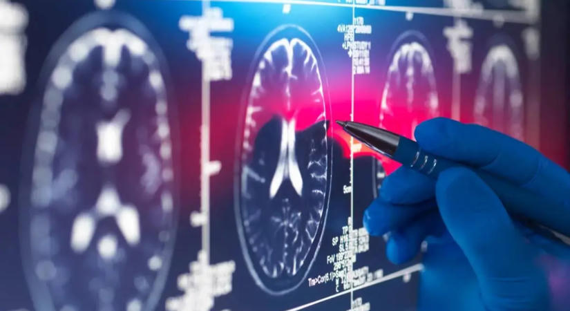 Akár 12,6 évvel tovább élhetünk demencia nélkül, ha ezt a három veszélyt elkerüljük