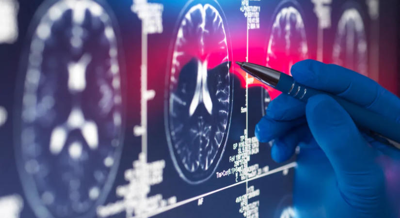 Évekkel a tünetek előtt lebukhat az Alzheimer-kór