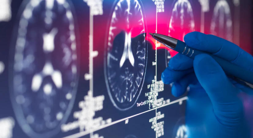 Így csökkentheted a demencia kockázatát, ha elmúltál 50 éves