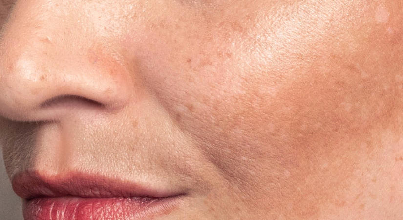 Pigmentbajusz, sötét foltok az arcon nyár végén: 5 bőrápolási tipp a fotoöregedés ellen