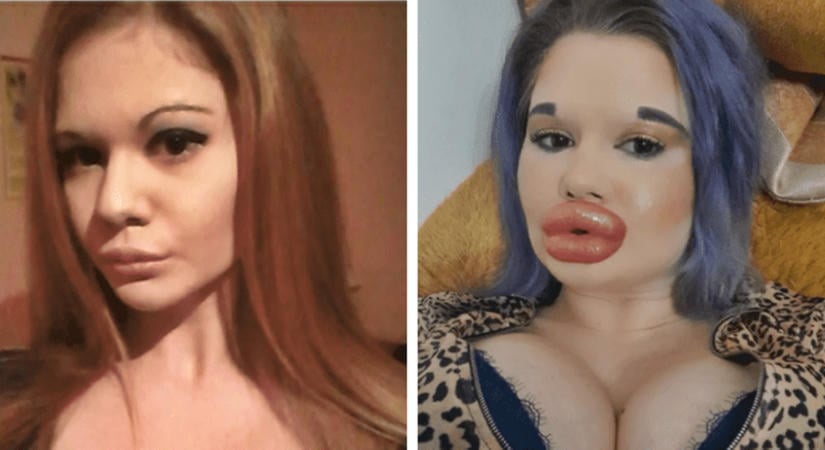 Végképp eltorzult az arca! Rémmé műtette magát az élő Barbie-baba (Fotók!)