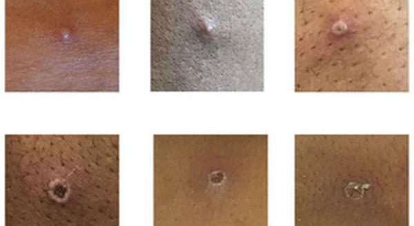 Virológus a majomhimlőről: aggodalomra nincs ok