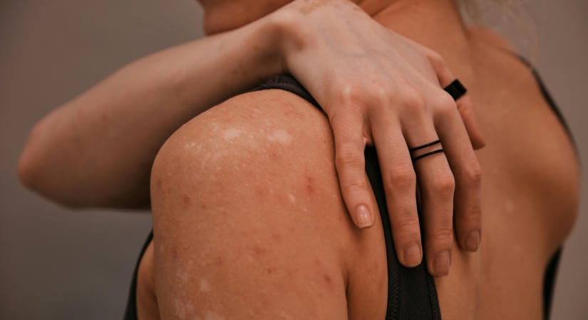 Magyarországon is megjelent a nehezen kezelhető bőrgomba – ilyen kör alakú foltok jelzik!