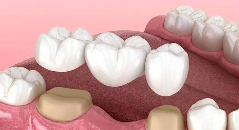 Koronák és hidak a győri Smile Zentrum Fogászati Klinikánál