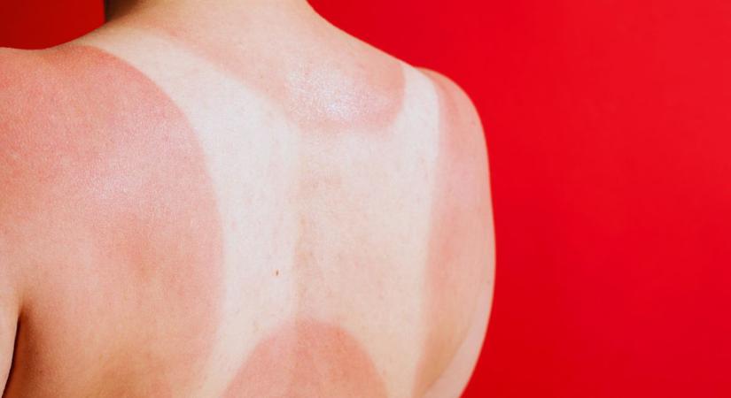8 testrész, ahová a legtöbben elfelejtenek fényvédőt kenni – pedig itt is kialakulhat bőrrák