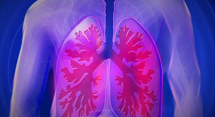 Ingyenes tüdőrákszűrésre várja az 50 feletti aktív dohányosokat az országos pulmonológiai intézet