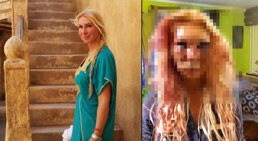 „Hét év után vége a szenvedésnek” – helyrehozták Orosz Bernadett orrát, amelyet brutálisan széttört a volt párja