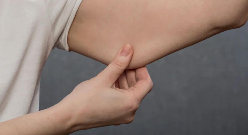 Így tüntetheted el az integetőhájat különösebb erőfeszítés nélkül