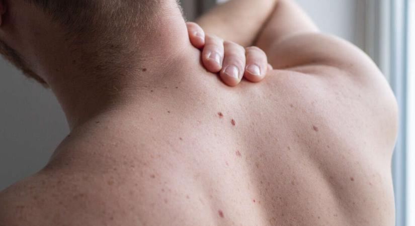 Kertelés nélkül kimondta: bőrrák – szóval csak óvatosan a nappal!