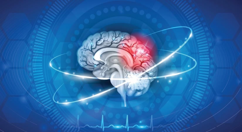 Elsőként Kecskeméten alkalmaztak újfajta stroke-kezelést Magyarországon