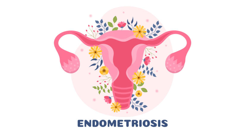 Probiotikummal az endometriózis ellen?