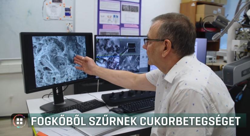Fogkőből mutathatják ki a cukorbetegséget debreceni kutatók