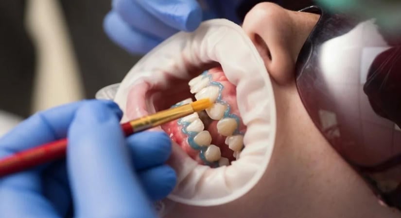 Ne dőlj be a legújabb fogfehérítő őrületeknek – otthoni trükkök, amikre garantáltan ráfizetsz