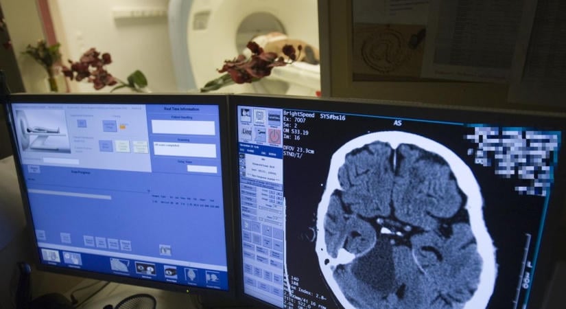 Ijesztően gyakoribb lett a stroke a fiatalok körében, és még nem jöttek rá, miért