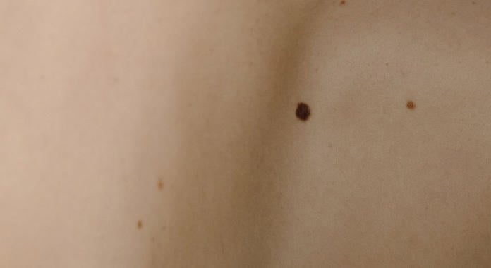 Barnulás Egyre több a bőrrákos fiatal?